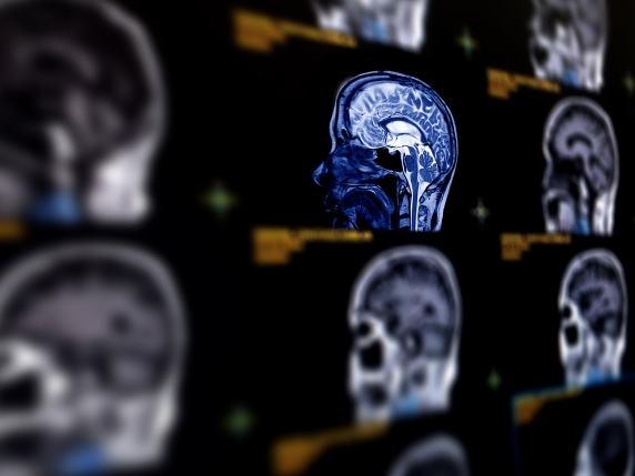 La riabilitazione post-ictus dovrebbe iniziare in tempi precoci