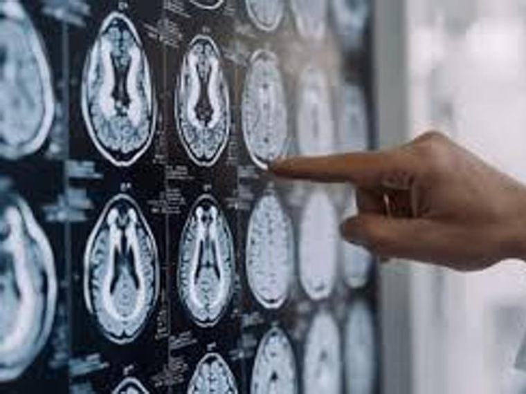 Morbo di Parkinson, cos’è e quali sono i sintomi