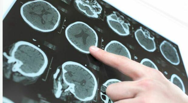 Parkinson, i sintomi da non sottovalutare: diagnosi, cure e aspettative di vita