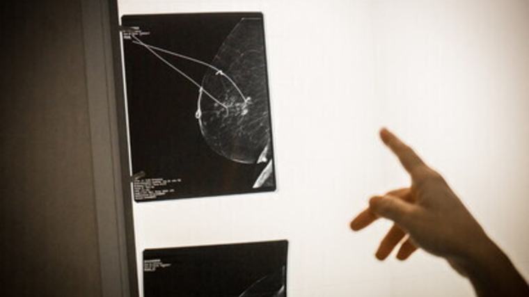 Donna scopre di avere un tumore al seno, l'unica spia era il cattivo odore